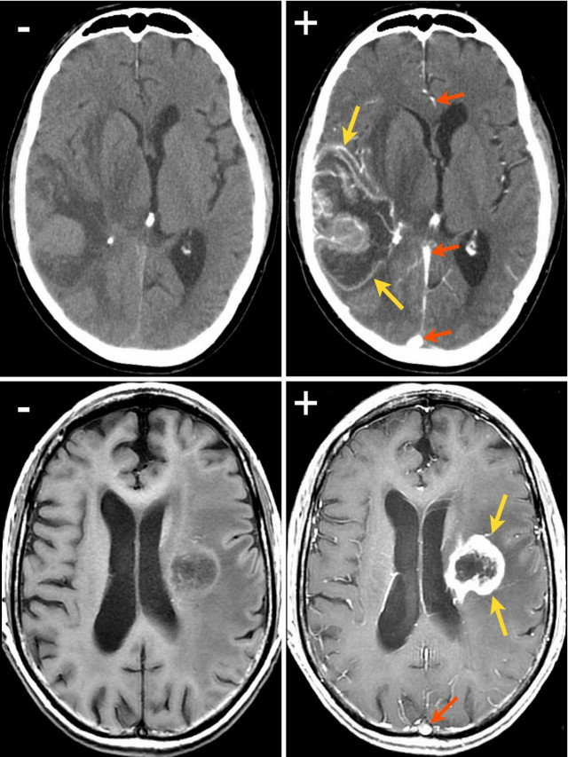 รวมกัน 95+ ภาพ ct brain contrast vs non contrast คือ ใหม่ที่สุด