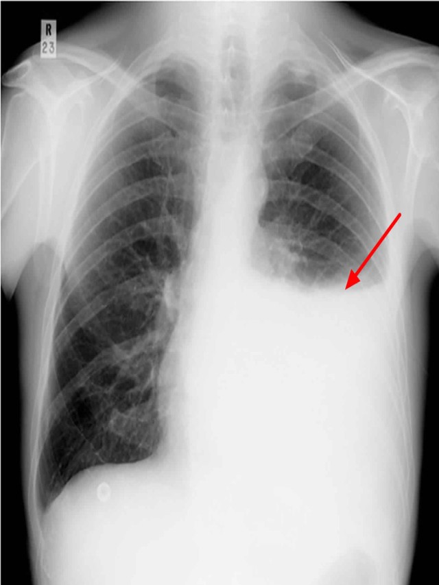 รายการ 98+ ภาพ pleural effusion พยาธิสภาพ อัปเดต